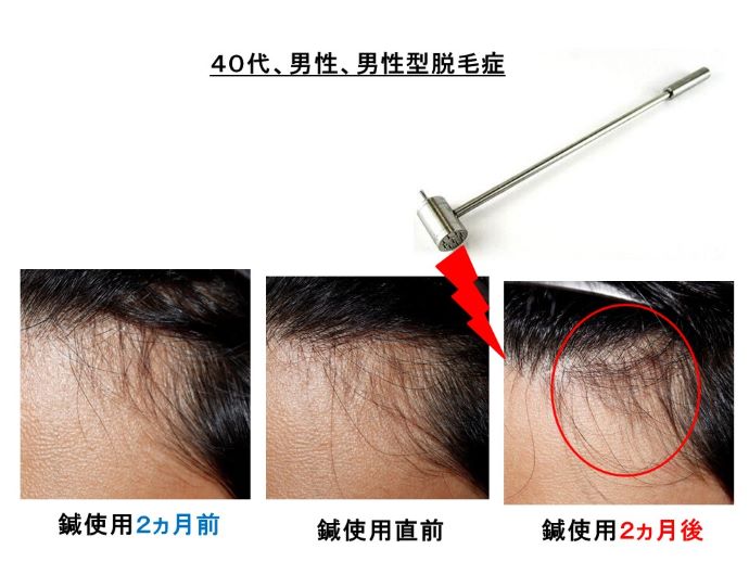 円形脱毛症　病院